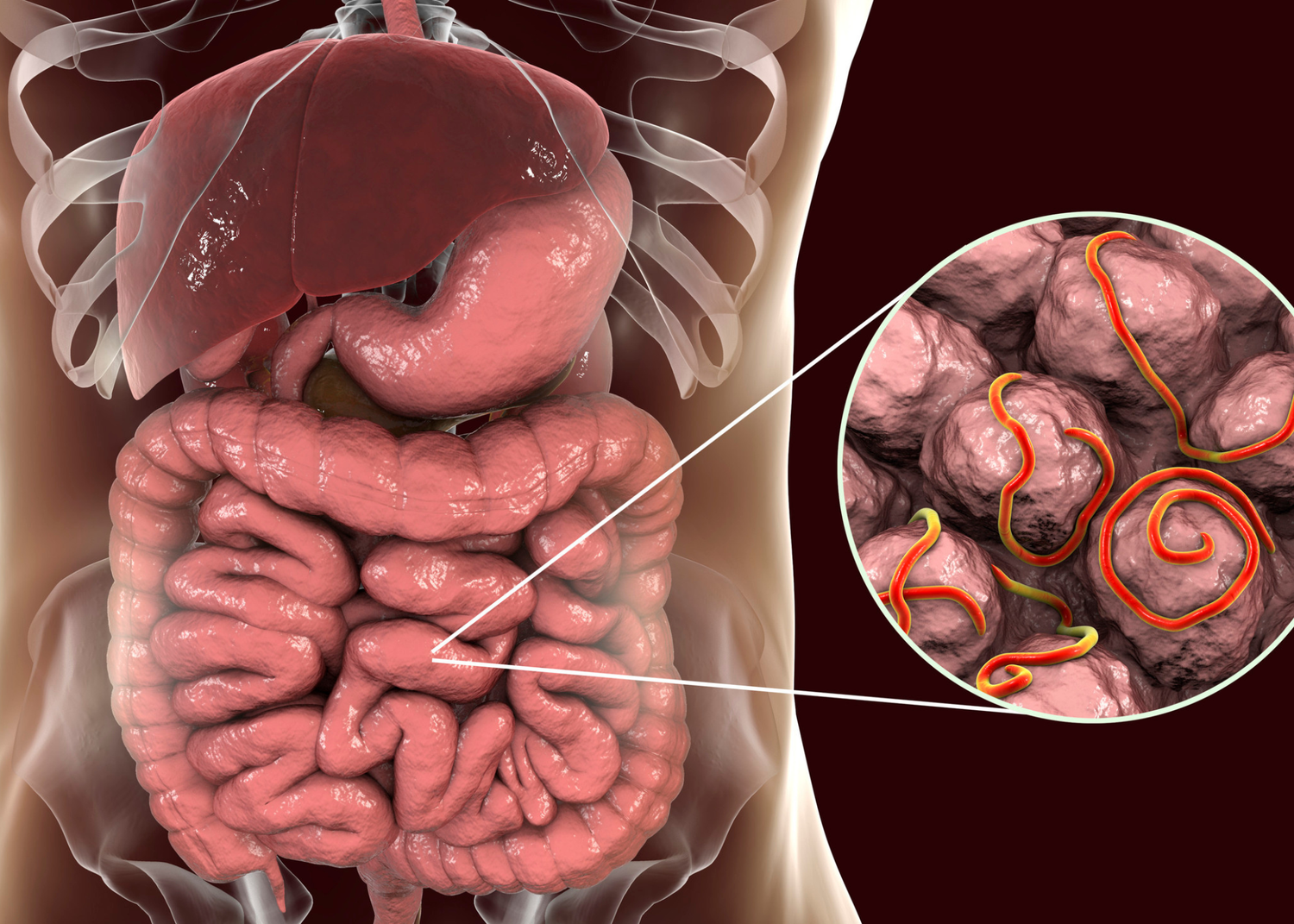 Could Parasites Be Living in Your Gut?